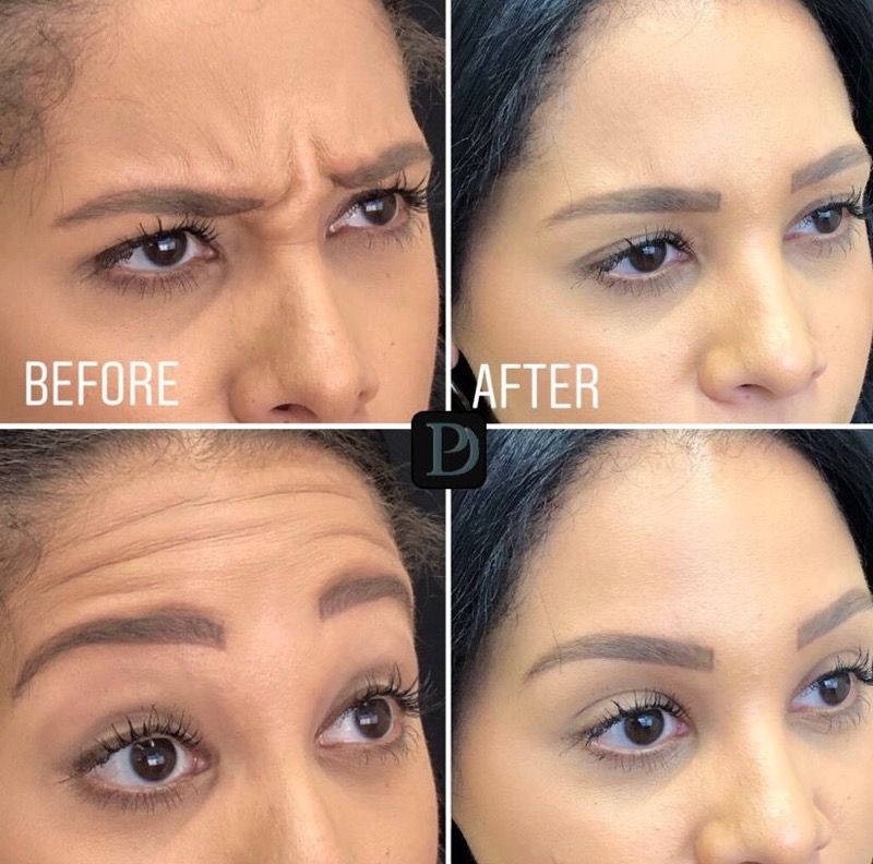 Bowling Green Botox & Juvederm | Precision Dental